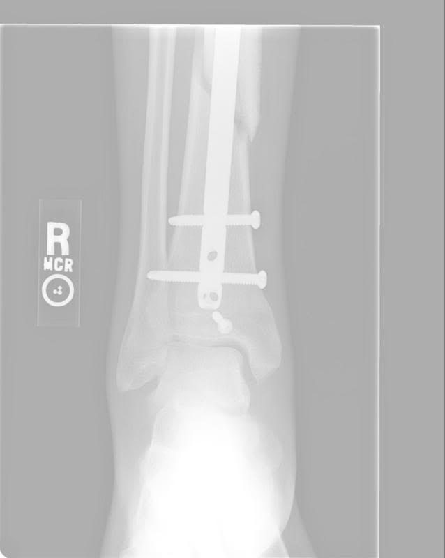 Dr Mark A Tibia Radial Fracture Question Health And Fitness Thumpertalk