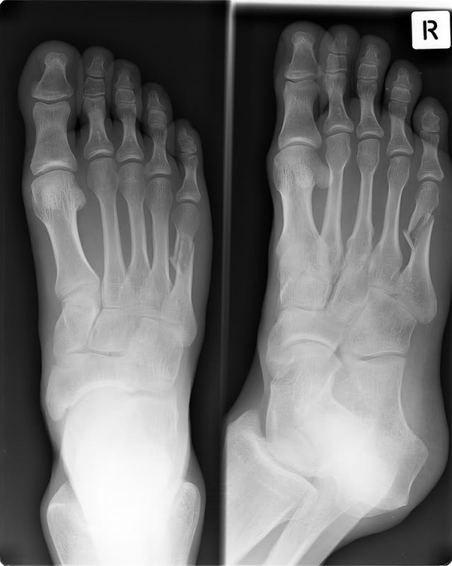 Broken Metatarsal Help - Health & Fitness - ThumperTalk