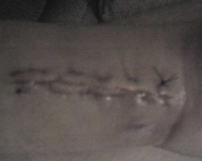 Pics of my wrist after surgery (semigraphic) - Dirt Bike Pictures ...